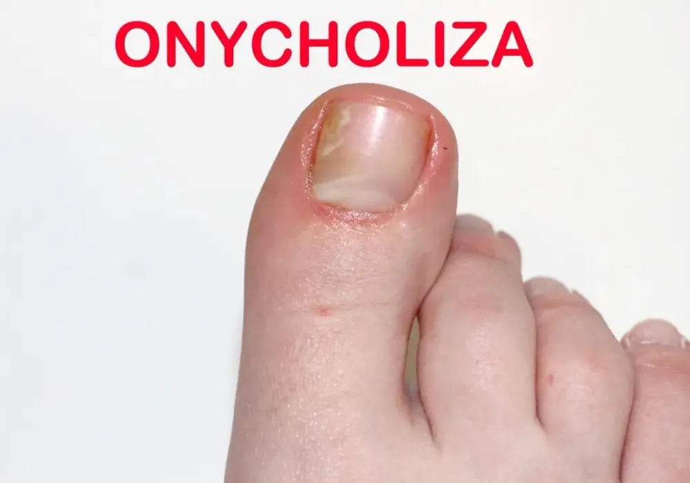 Onycholiza po hybrydzie: skuteczne metody leczenia i zapobiegania