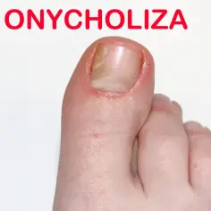 Onycholiza po hybrydzie: skuteczne metody leczenia i zapobiegania