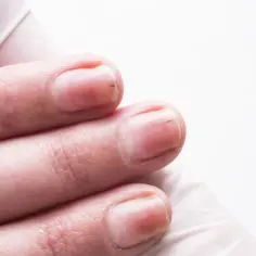 Alergia na hybrydy: objawy, jak rozpoznać i leczyć reakcję